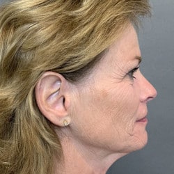 Before Image: Facelift, Dermabrasion, Lower Blepharoplasty by Dr. Thompron - right-side