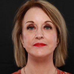 After Image: Facelift by Dr. Henstrom - front