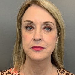 Before Image: Facelift by Dr. Henstrom - front