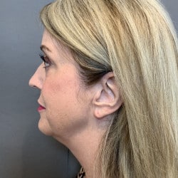 Before Image: Facelift by Dr. Henstrom - left-side