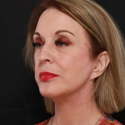 After Image: Facelift by Dr. Henstrom - left-front-oblique