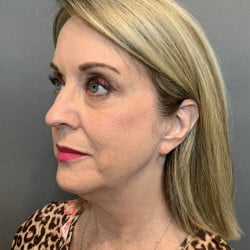 Before Image: Facelift by Dr. Henstrom - left-front-oblique