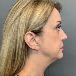 Before Image: Facelift by Dr. Henstrom - right-side