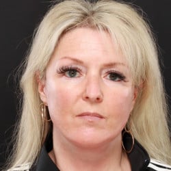 After Image: Facelift by Dr. Thompson - front