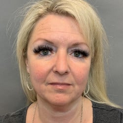 Before Image: Facelift by Dr. Thompson - front