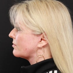 After Image: Facelift by Dr. Thompson - left-side
