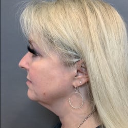 Before Image: Facelift by Dr. Thompson - left-side