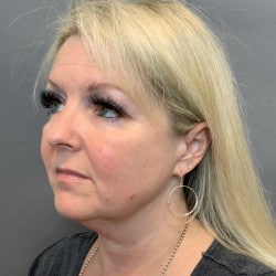 Before Image: Facelift by Dr. Thompson - left-front-oblique