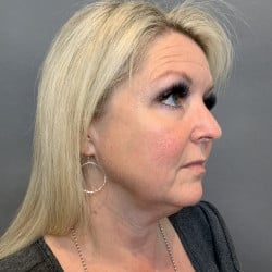 Before Image: Facelift by Dr. Thompson - right-front-oblique