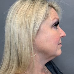 Before Image: Facelift by Dr. Thompson - right-side