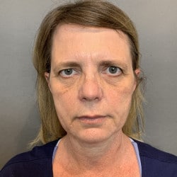 Before Image: Facelift, Browlift, Fat Transfer, Lip Lift, Upper Blepharoplasty, and Skin Pinch by Dr. Thompson - front