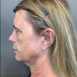 Before Image: Facelift, Browlift, Fat Transfer, Lip Lift, Upper Blepharoplasty, and Skin Pinch by Dr. Thompson - left-side
