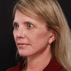 After Image: Facelift, Browlift, Fat Transfer, Lip Lift, Upper Blepharoplasty, and Skin Pinch by Dr. Thompson - left-front-oblique