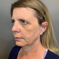 Before Image: Facelift, Browlift, Fat Transfer, Lip Lift, Upper Blepharoplasty, and Skin Pinch by Dr. Thompson - left-front-oblique