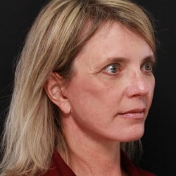 After Image: Facelift, Browlift, Fat Transfer, Lip Lift, Upper Blepharoplasty, and Skin Pinch by Dr. Thompson - right-front-oblique