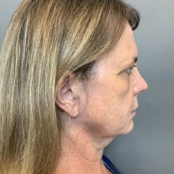 Before Image: Facelift, Browlift, Fat Transfer, Lip Lift, Upper Blepharoplasty, and Skin Pinch by Dr. Thompson - right-side
