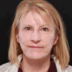 After Image: Facelift & Dermabrasion by Dr. Thompson - front