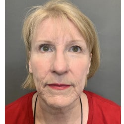 Before Image: Facelift & Dermabrasion by Dr. Thompson - front