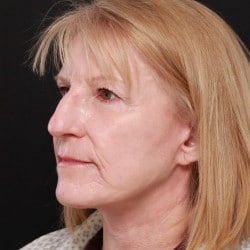 After Image: Facelift & Dermabrasion by Dr. Thompson - left-front-oblique