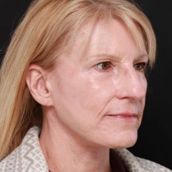 After Image: Facelift & Dermabrasion by Dr. Thompson - right-front-oblique