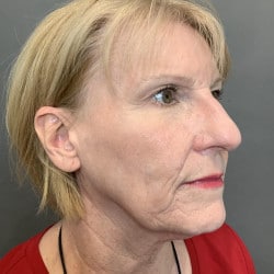 Before Image: Facelift & Dermabrasion by Dr. Thompson - right-front-oblique