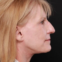 After Image: Facelift & Dermabrasion by Dr. Thompson - right-side