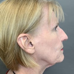 Before Image: Facelift & Dermabrasion by Dr. Thompson - right-side