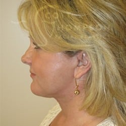 After Image: FACELIFT BEFORE AND AFTER PHOTOS | UTAH FACIAL PLASTICS 652 - left-side