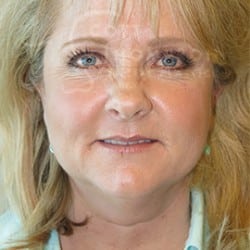 Before Image: FACELIFT BEFORE AND AFTER PHOTOS | UTAH FACIAL PLASTICS 652 - left-front-oblique