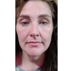 Before Image: Facelift by Dr. Thompson - front