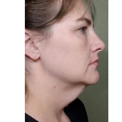 Before Image: Facelift by Dr. Thompson - right-side