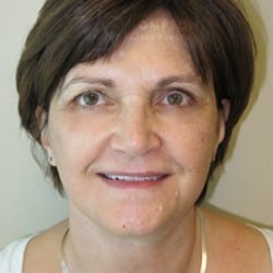 After Image: FACELIFT BEFORE AND AFTER PHOTOS | UTAH FACIAL PLASTICS 943 - front