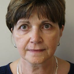 Before Image: FACELIFT BEFORE AND AFTER PHOTOS | UTAH FACIAL PLASTICS 943 - front