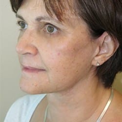 After Image: FACELIFT BEFORE AND AFTER PHOTOS | UTAH FACIAL PLASTICS 943 - left-front-oblique