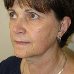 Before Image: FACELIFT BEFORE AND AFTER PHOTOS | UTAH FACIAL PLASTICS 943 - left-front-oblique