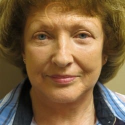 After Image: Facelift, Lower Blepharoplasty, an Perioral Dermabrasion by Dr. Thompson - front