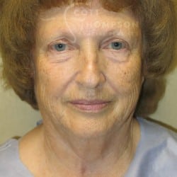Before Image: Facelift, Lower Blepharoplasty, an Perioral Dermabrasion by Dr. Thompson - front