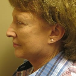 After Image: Facelift, Lower Blepharoplasty, an Perioral Dermabrasion by Dr. Thompson - left-side