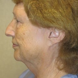 Before Image: Facelift, Lower Blepharoplasty, an Perioral Dermabrasion by Dr. Thompson - left-side