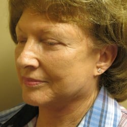 After Image: Facelift, Lower Blepharoplasty, an Perioral Dermabrasion by Dr. Thompson - left-front-oblique