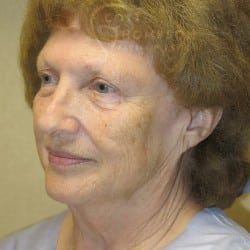 Before Image: Facelift, Lower Blepharoplasty, an Perioral Dermabrasion by Dr. Thompson - left-front-oblique