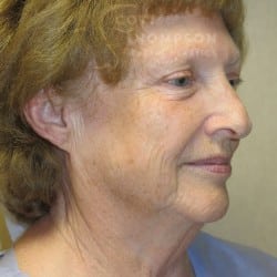 Before Image: Facelift, Lower Blepharoplasty, an Perioral Dermabrasion by Dr. Thompson - right-front-oblique