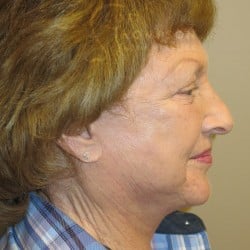 After Image: Facelift, Lower Blepharoplasty, an Perioral Dermabrasion by Dr. Thompson - right-side