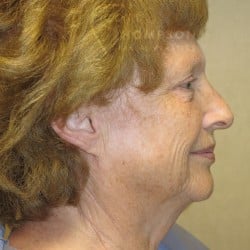Before Image: Facelift, Lower Blepharoplasty, an Perioral Dermabrasion by Dr. Thompson - right-side