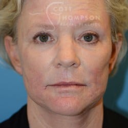 After Image: FACELIFT | FAT INJECTIONS | BROWLIFT | UPPER EYELID LIFT | PERIORAL DERMABRASION – 787 - front