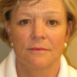 Before Image: FACELIFT | FAT INJECTIONS | BROWLIFT | UPPER EYELID LIFT | PERIORAL DERMABRASION – 787 - front