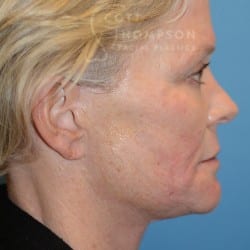 After Image: FACELIFT | FAT INJECTIONS | BROWLIFT | UPPER EYELID LIFT | PERIORAL DERMABRASION – 787 - right-side