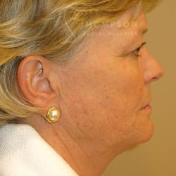 Before Image: FACELIFT | FAT INJECTIONS | BROWLIFT | UPPER EYELID LIFT | PERIORAL DERMABRASION – 787 - right-side