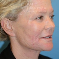 After Image: FACELIFT | FAT INJECTIONS | BROWLIFT | UPPER EYELID LIFT | PERIORAL DERMABRASION – 787 - right-front-oblique