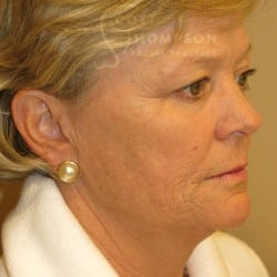 Before Image: FACELIFT | FAT INJECTIONS | BROWLIFT | UPPER EYELID LIFT | PERIORAL DERMABRASION – 787 - right-front-oblique